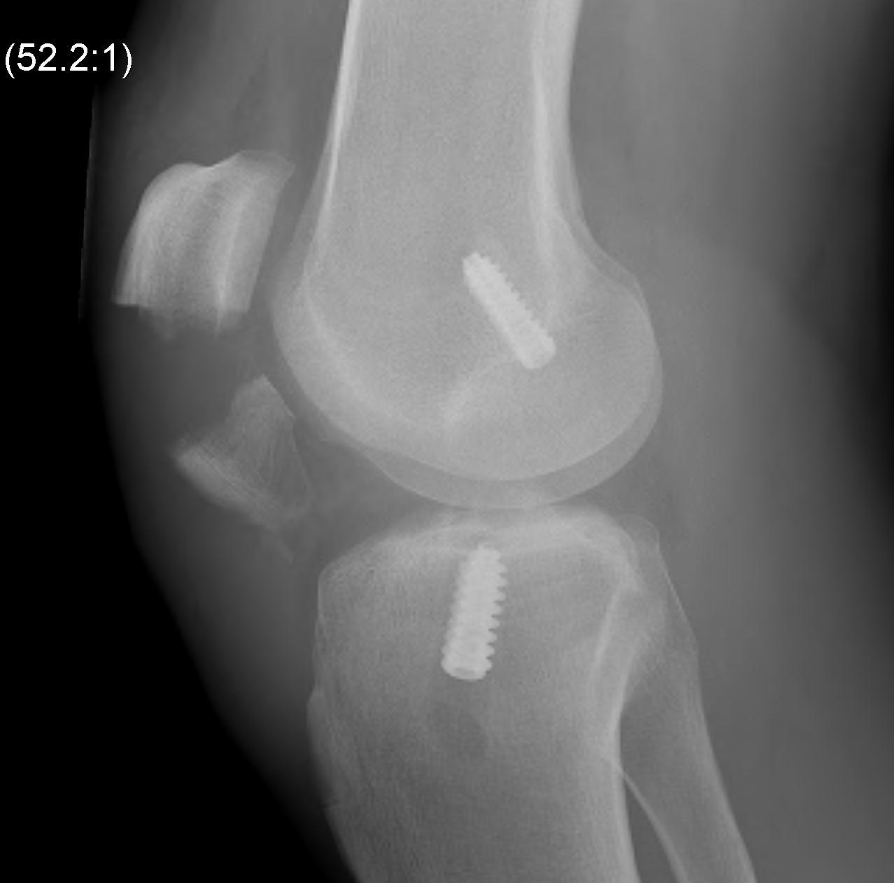 ACL BPTP Patella Fracture Lateral